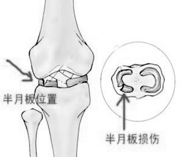 半月板治療新進(jìn)展揭秘，巷弄深處的醫(yī)學(xué)奧秘探索